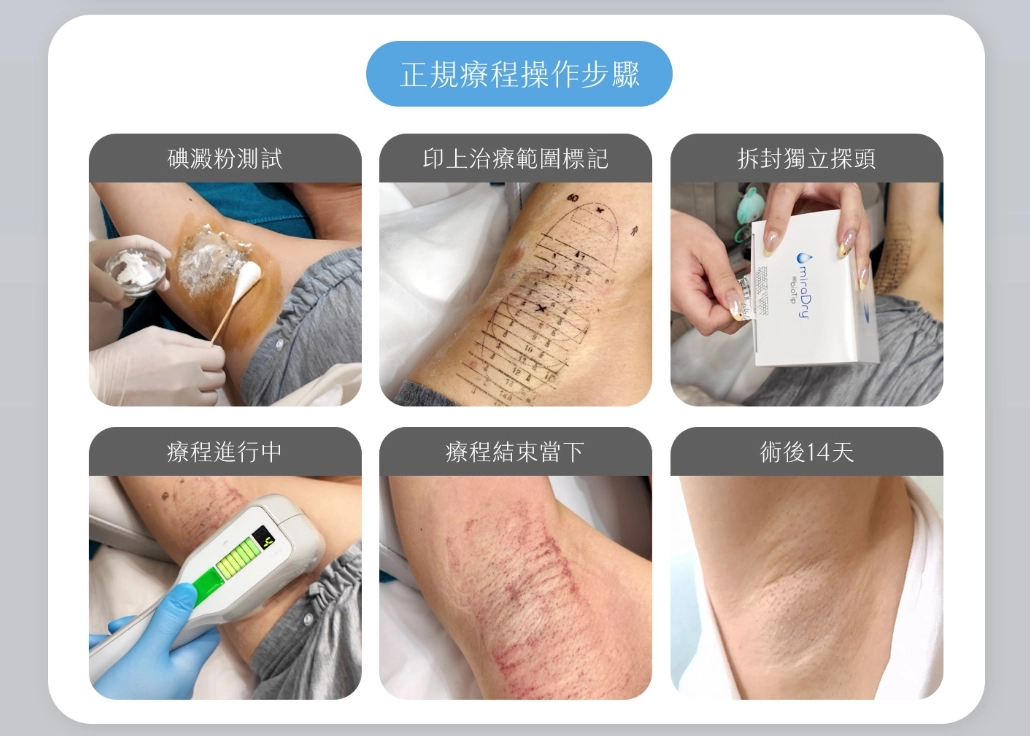miraDry 清新微波正規療程操作步驟