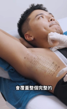 miraDry 療程紀錄影片畫面一