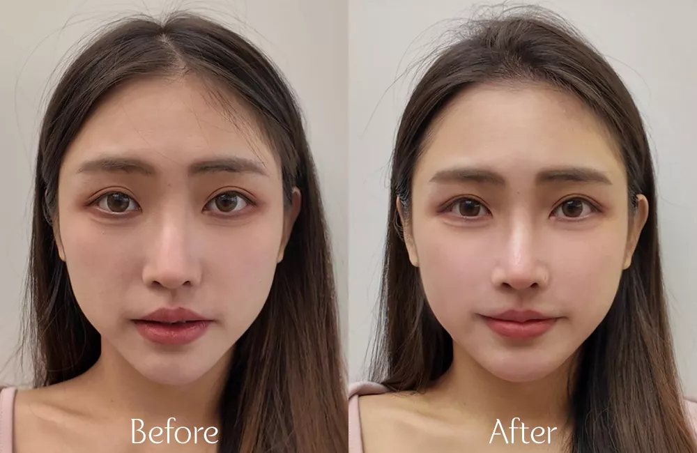 玻尿酸法令紋與外輪廓順修