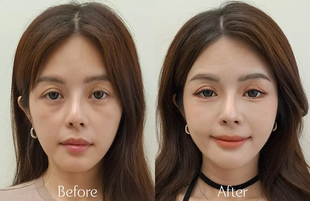 玻尿酸填補淚溝