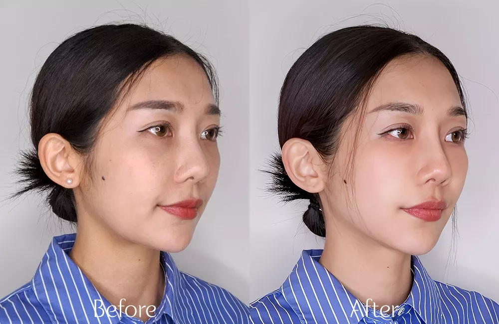 電音波拉提緊緻